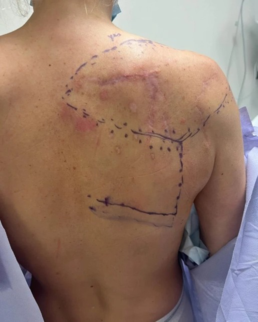 a man's back with surgery marks drawn on the skin