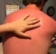 image of a hand resting on a heavily-sunburned back of a man