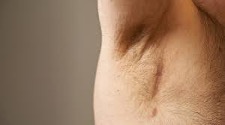 David's armpit showing the drain scar