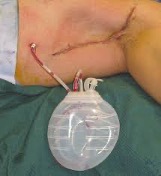 Drain inserted in David's armpit